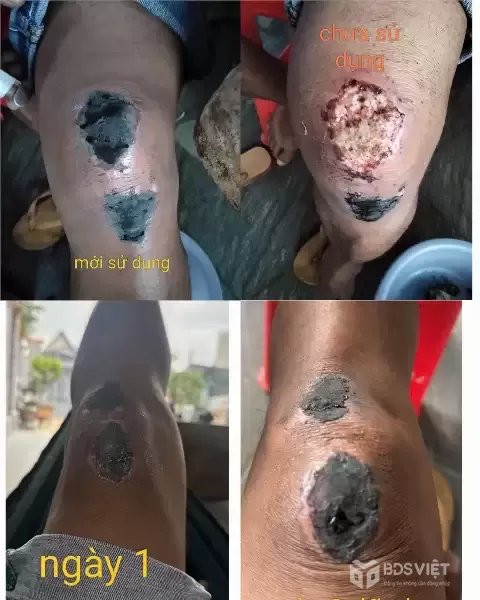 BỘT KHÔ SÁT VẾT THƯƠNG – GIẢI PHÁP Giúp Vết Thương Nhanh Lành, Nhanh Khô An Toàn - BỘT KHÔ Y SĨ VINH.