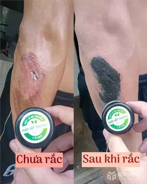 BỘT KHÔ SÁT VẾT THƯƠNG – GIẢI PHÁP Giúp Vết Thương Nhanh Lành, Nhanh Khô An Toàn - BỘT KHÔ Y SĨ VINH.