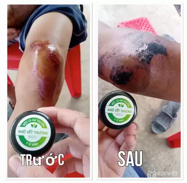 BỘT KHÔ SÁT VẾT THƯƠNG – GIẢI PHÁP Giúp Vết Thương Nhanh Lành, Nhanh Khô An Toàn - BỘT KHÔ Y SĨ VINH.