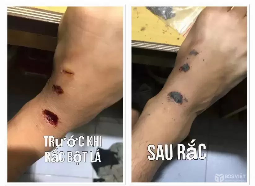 BỘT KHÔ SÁT VẾT THƯƠNG – GIẢI PHÁP Giúp Vết Thương Nhanh Lành, Nhanh Khô An Toàn - BỘT KHÔ Y SĨ VINH.